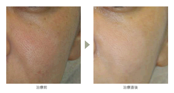 refirm_image_before refirm_image_before